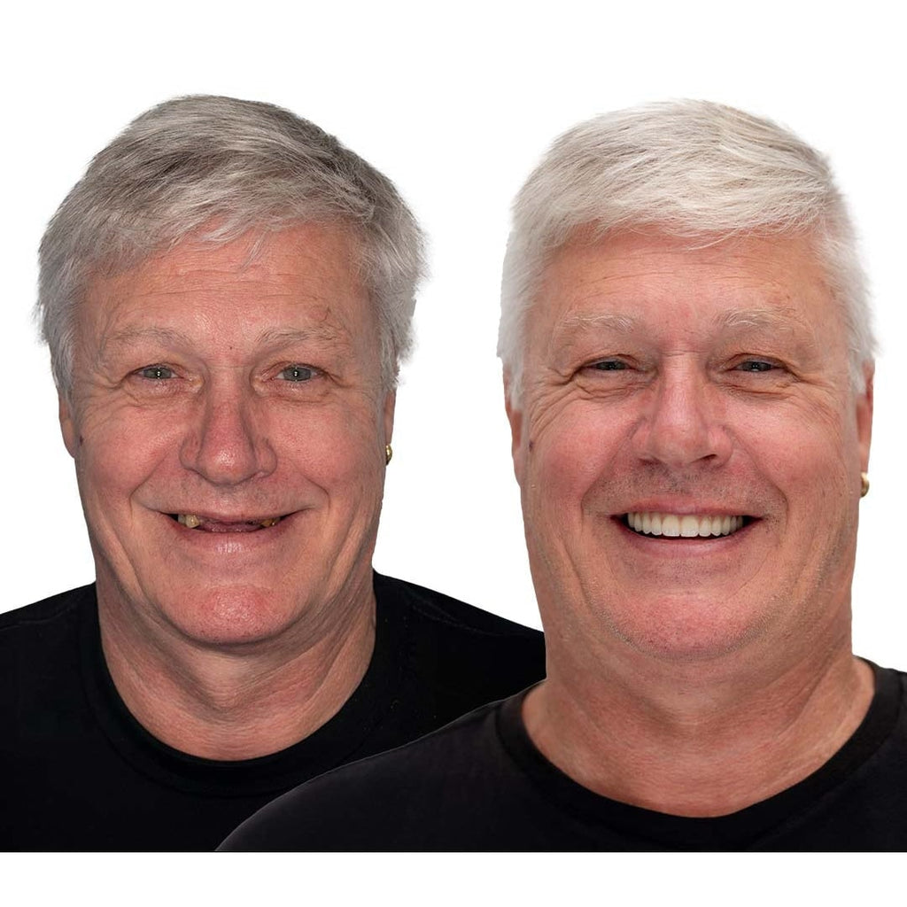 Men's Removable Dentures with Flexible Cushion Grip Storage Case and Realistic Upper Lower Arches - Image 11