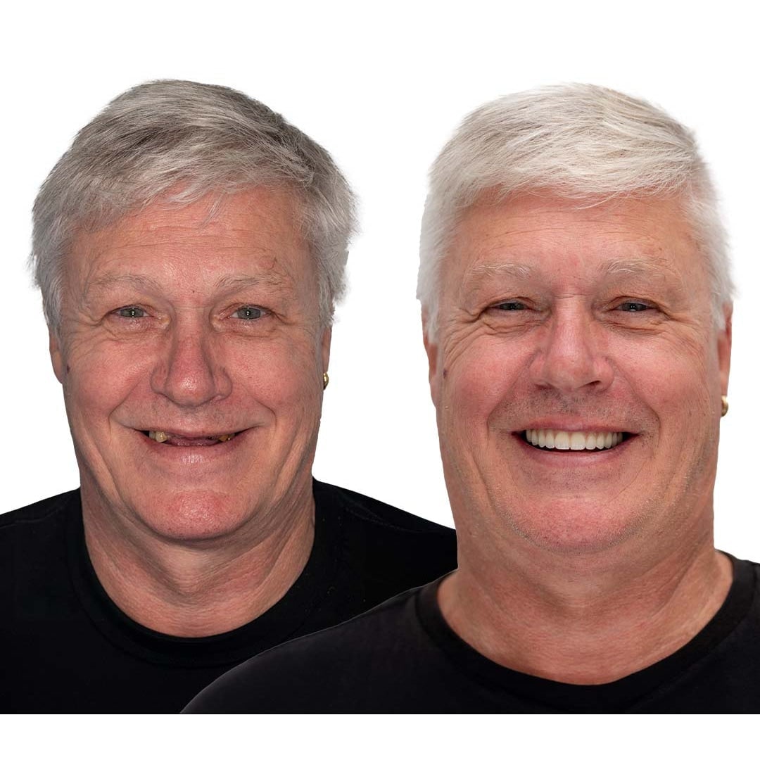 Men's Removable Dentures with Flexible Cushion Grip Storage Case and Realistic Upper Lower Arches - Image 11