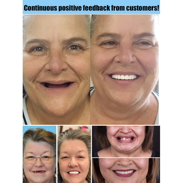 Snap on Veneers Upper and Lower Teeth with Moldable Cosmetic Resin and Adjustable Fit - Image 5